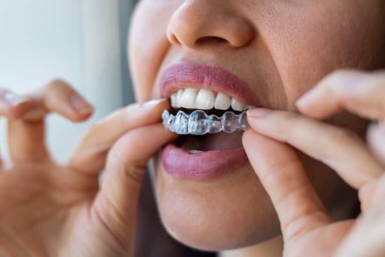 Close up of a woman putting on her Invisalign clear aligners as part of her daily routine