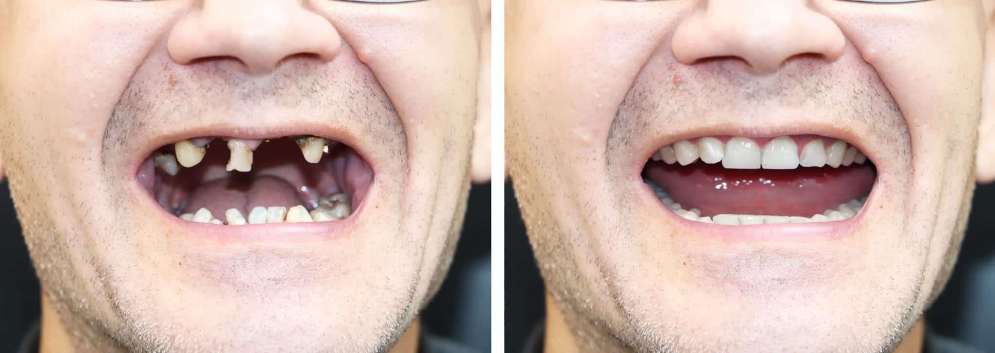 Before and after of a full mouth reconstruction
