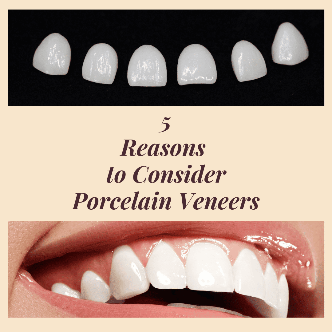 5 Reasons to Consider porcelain veneers