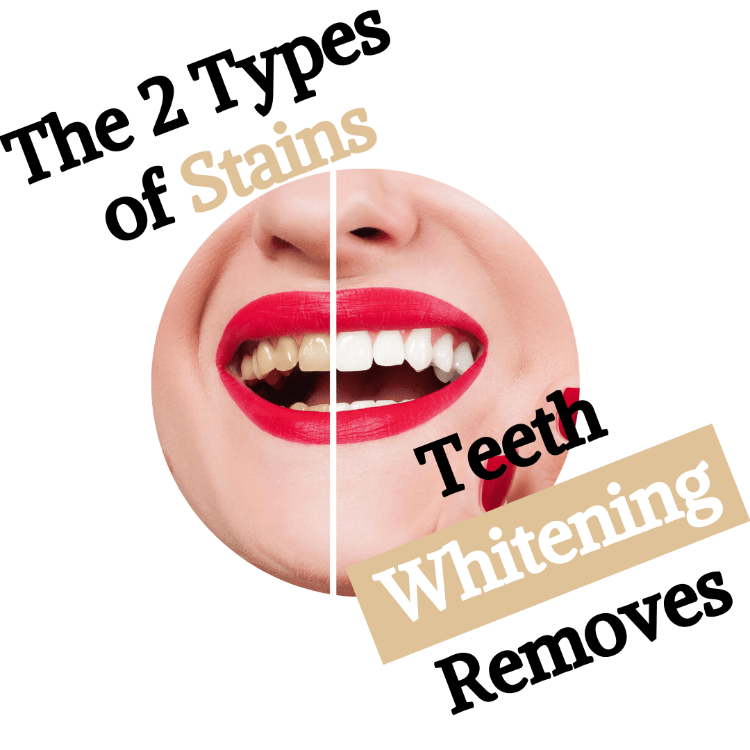 The 2 Types of Stains Teeth Whitening Removes