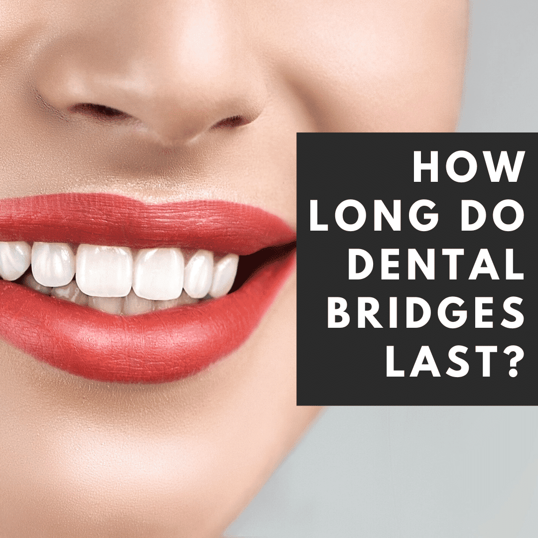 How Long Do Dental Bridges Last_