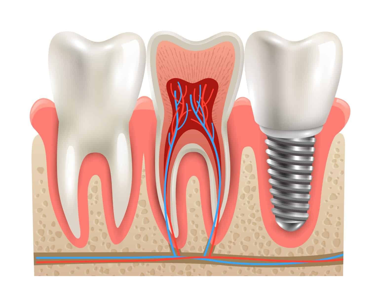 How Do Dental Implants Preserve Bone Mass? Lerner & Lemongello Cosmetic and Restorative