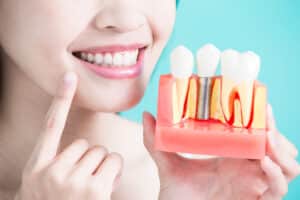 Close up of a woman holding a diorama of a dental implant in consideration and unsure of the longevity of the treatment.