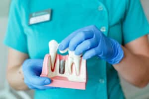 Dentist holding a model of a tooth implant and bridge during consult about a missing tooth