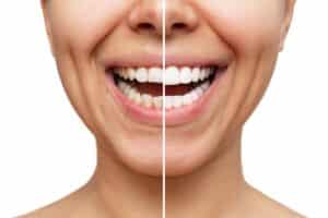 Before and after image of a woman's mouth who received dental veneers to correct her short, uneven teeth