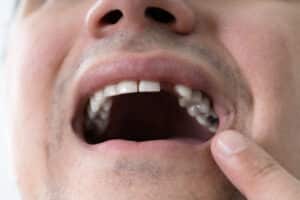 Close up of a man poking at his missing tooth, in need of a dental bridge to prevent future damage.