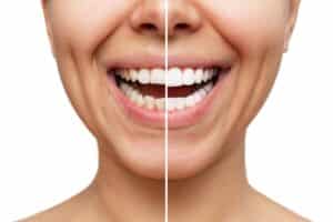 Before and after of a woman smiling, showing how her teeth are whiter after treatment.