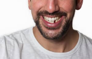 Close-up of a smiling man showing where he is missing a tooth, in need of replacement treatment.